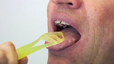 Zungenpflege: Zungenreiniger können helfen, Beläge auf der Zunge auch in den hinteren Bereichen zu entfernen, ohne Würgereiz auszulösen. Alternativ kann die Zunge auch nur mit der Zahnbürste (ggf. mit den Fingern über eine Kompresse an der Spitze gehalten) gereinigt werden.