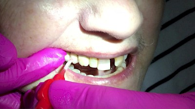 Zahnpflege: Interdentalbürste (Zahnzwischenraumbürste) Seitenzähne