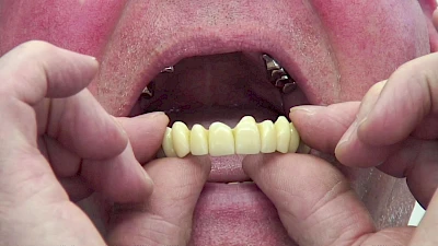 Beispiele: Aus- & Eingliederung von Zahnprothesen