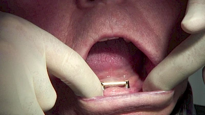 Beispiele: Aus- & Eingliederung von Zahnprothesen