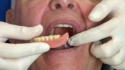 Beispiele: Aus- & Eingliederung von Zahnprothesen