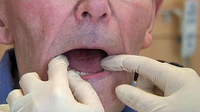 Beispiele: Aus- & Eingliederung von Zahnprothesen