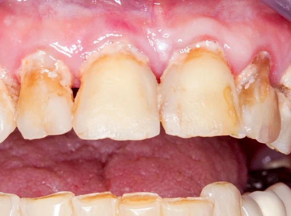 Zahn, Füllung, Krone & Brücke Belag 