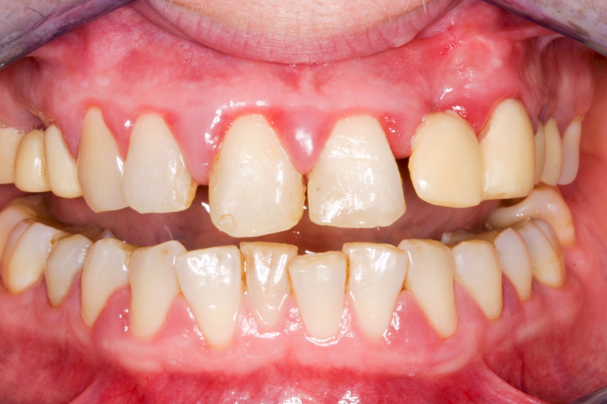 Auffälligkeiten & Probleme Zahnfleisch 