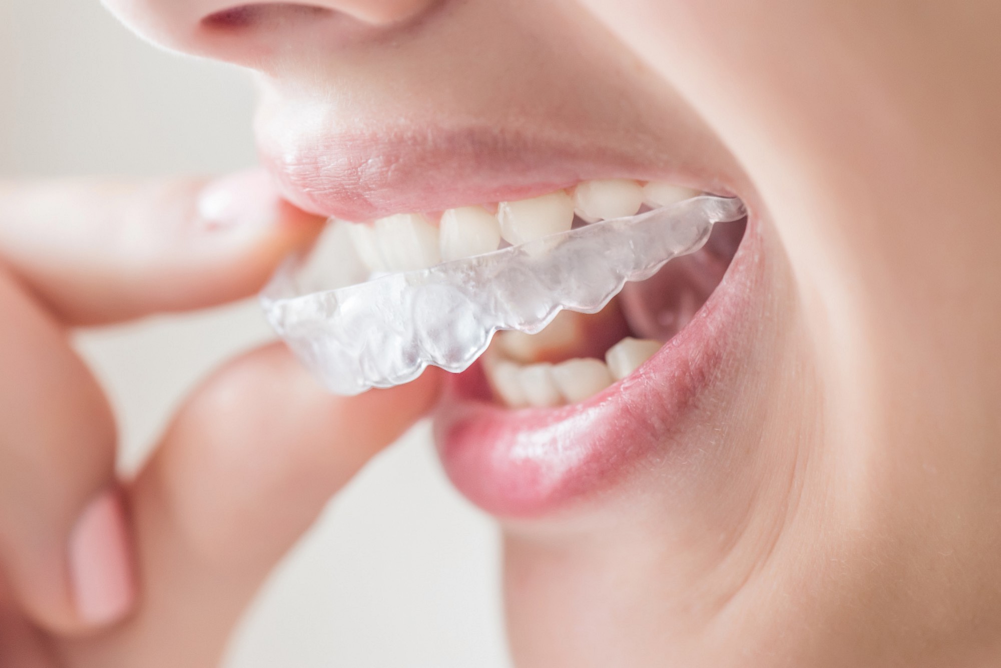 Zahnärztliche Versorgungen Zahnspange & Schiene 