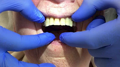 Beispiele: Aus- & Eingliederung von Zahnprothesen