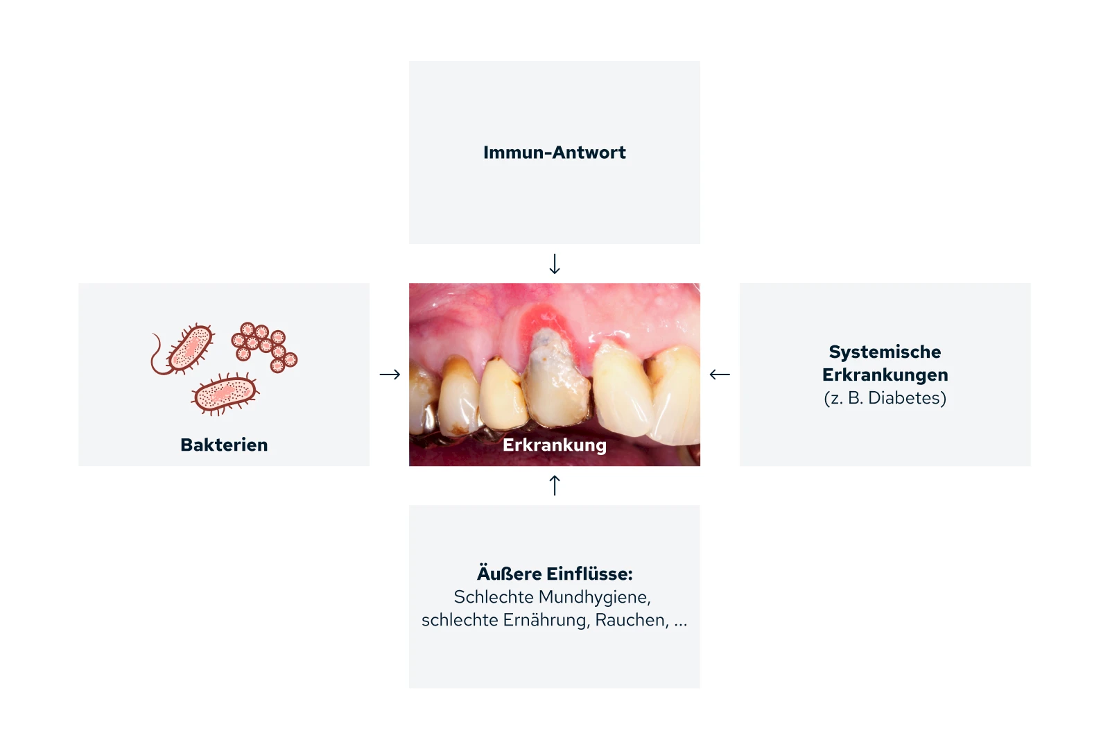 Gingivitis & Parodontitis: Multifaktorielles Geschehen