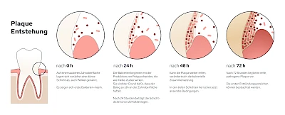 Plaque Entstehung