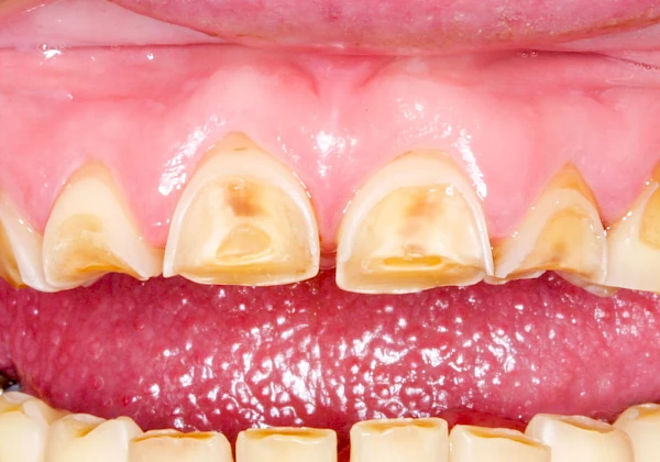 Zahn, Füllung, Krone & Brücke Abnutzung & Auswaschung