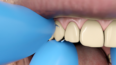 Mit dem Fingernagel vom Zahnfleisch her die Klammern auf beiden Seiten vorsichtig von den Zähnen lösen und dann die Prothese auf beiden Seiten gehalten aus dem Mund führen.
