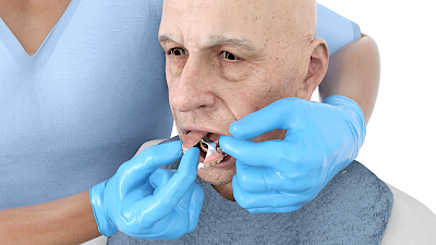 Zum Einsetzen die Prothese in den Mund eindrehen und dabei auf der einen Seite mit der Prothese die Wange "aufnehmen", auf der anderen Seite ggf. mit dem Finger die Wange abhalten.