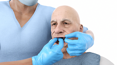 Zunächst die Prothese über dem Zahnbogen positionieren.
