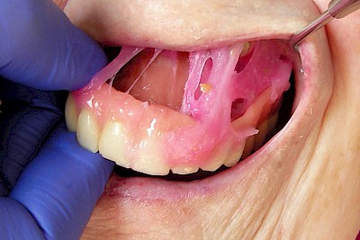 Weniger ist mehr! Wenn so viel Haftcreme notwendig ist, um die Prothese zum Halten zu bringen, dann sollte ein Zahnarzt prüfen, ob eine Unterfütterung der Prothese angezeigt ist.