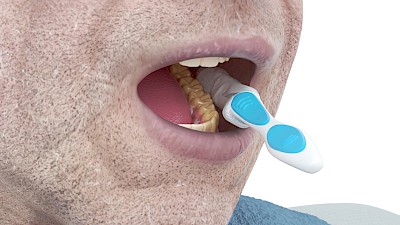 Zwischendurch Zahnpastaschaum und gelöste Beläge ausspucken lassen oder den Mund mit einer Kompresse auswischen.