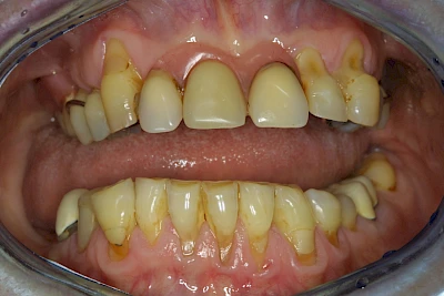 Beispiele: Auswaschung