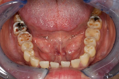 Beispiele: Auswaschung