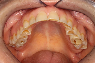 Beispiele: Auswaschung