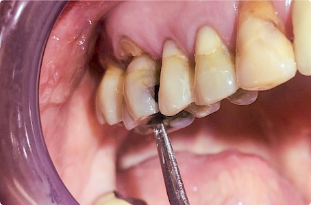 Beweglichkeit Zahn