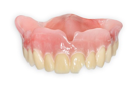 Absplitterung Zahnprothese