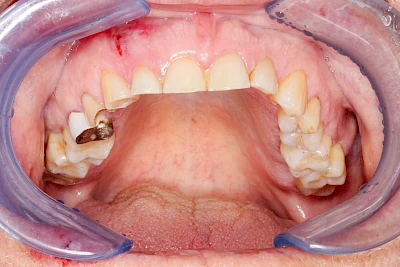 Beispiel: Zusammenstoß
