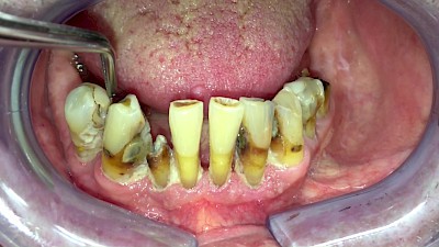 Beispiele: Zahn, Füllung & Krone