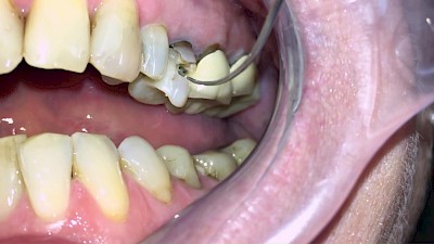 Beispiele: Zahn, Füllung & Krone