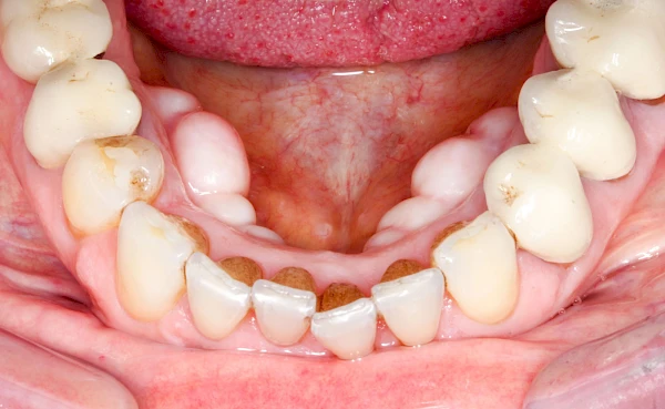 Auffälligkeiten im Mund Kieferknochen 