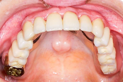 Beispiele: Überbein (Exostose)