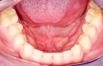 Beispiele: Überbein (Exostose)