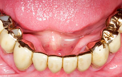 Beispiele: Überbein (Exostose)