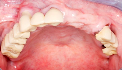 Beispiele: Überbein (Exostose)