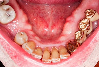 Beispiele: Überbein (Exostose)