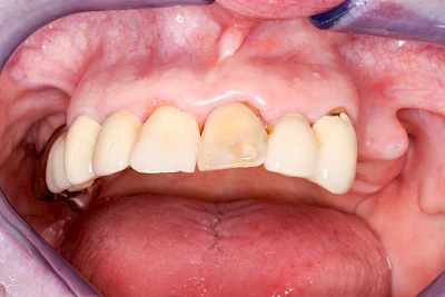 Beispiele: Überbein (Exostose)