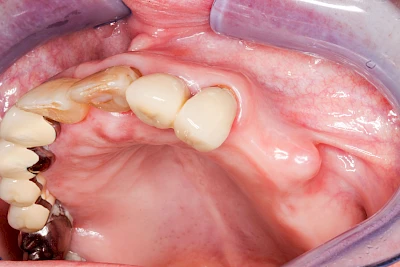 Beispiele: Überbein (Exostose)