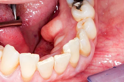 Beispiele: Überbein (Exostose)