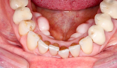 Beispiele: Überbein (Exostose)