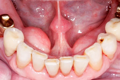 Beispiele: Überbein (Exostose)