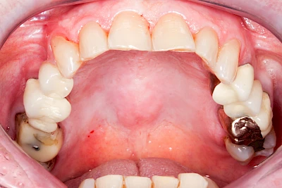 Beispiele: Überbein (Exostose)