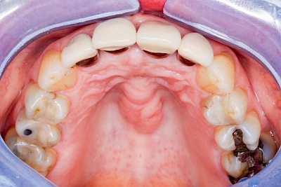 Beispiele: Überbein (Exostose)