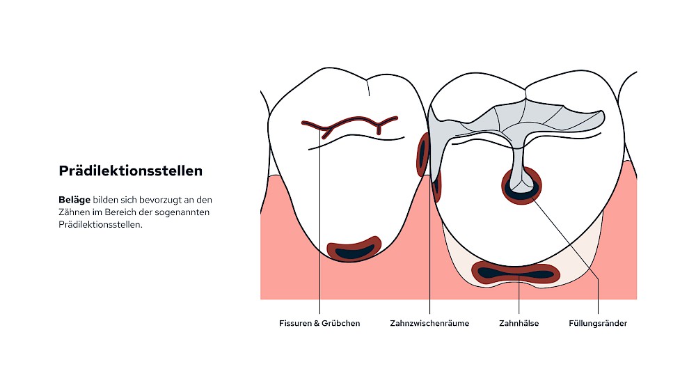 Karies: Prädilektionsstellen
