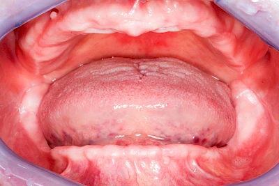 Beispiele: Knochenschwund Oberkiefer