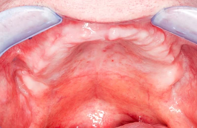 Beispiele: Knochenschwund Oberkiefer