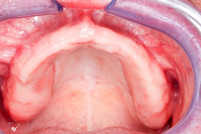Beispiele: Knochenschwund Oberkiefer