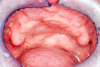 Beispiele: Knochenschwund Oberkiefer