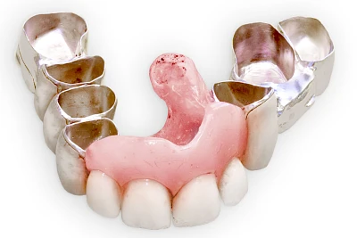 Beispiele: Lippen-Kiefer-Gaumenspalte