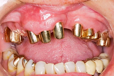 Beispiele: Lippen-Kiefer-Gaumenspalte