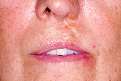 Beispiele: Lippen-Kiefer-Gaumenspalte