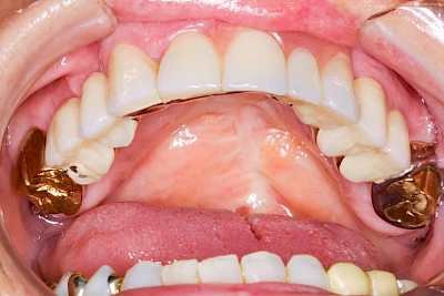 Beispiele: Lippen-Kiefer-Gaumenspalte