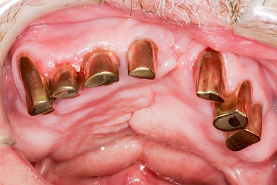 Beispiele: Lippen-Kiefer-Gaumenspalte