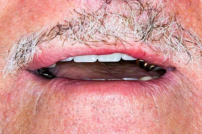 Beispiele: Lippen-Kiefer-Gaumenspalte